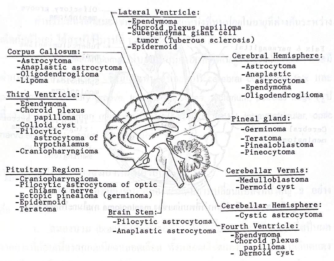แผนภาพตำแหน่งเนื้องอกสมองในเด็ก พร้อมรายชื่อเนื้องอกตามบริเวณต่าง ๆ