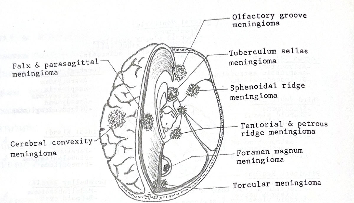 ตำแหน่ง meningioma ได้แก่ falx และ parasagittal, cerebral convexity, olfactory groove, tuberculum sellae, sphenoidal ridge, tentorial และ petrous ridge, foramen magnum และ torcular